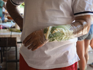 woman wrist wrapped with cabbage leaves compress for anti inflammatory pain relief.