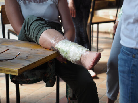 Woman Wearing Anti Inflammatory Cabbage Leaves Compress In Foot.