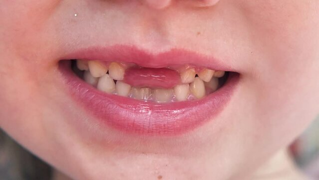Child's mouth with missing front milk teeth. Care for children's teeth. Girl opens her mouth and shows her missing teeth. Close-up