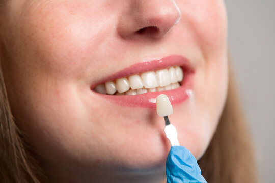 Close-up of dentist using shade guide at woman's mouth to check veneer of teeth for bleaching