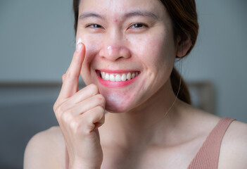 Happiness Asian woman applying acne cream on her face for treating acne and redness skin.