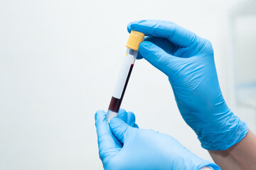 blood donation. A doctor in sterile gloves holds a vial of blood