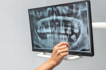 Close-up dentist hand explore teeth x-ray on monitor describe therapy to patient at dentistry...