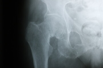Surgical plates for osteosynthesis in case of bone fractures	