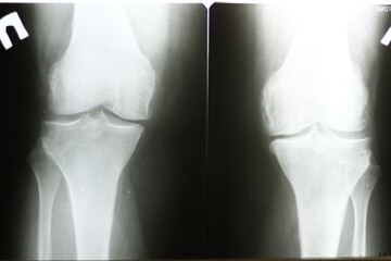 Surgical plates for osteosynthesis in case of bone fractures	