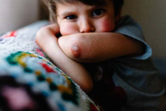 Little boy shows skinned elbow