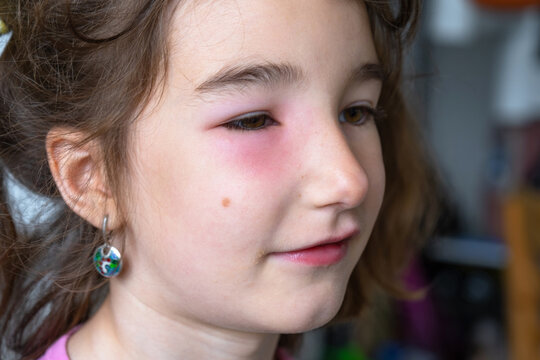 A red swollen eyelid on a child  face in close-up is an allergy to an insect bite. Allergic reaction to blood-sucking insects