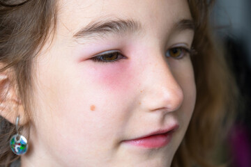 A red swollen eyelid on a child  face in close-up is an allergy to an insect bite. Allergic...