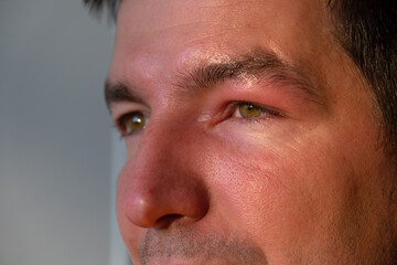 A red swollen eyelid on a man's face in close-up is an allergy to an insect bite. Allergic reaction...