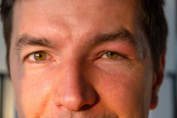 Obraz premium A red swollen eyelid on a man's face in close-up is an allergy to an insect bite. Allergic reaction to blood-sucking insects