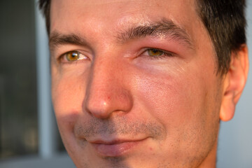 Obraz premium A red swollen eyelid on a man's face in close-up is an allergy to an insect bite. Allergic reaction to blood-sucking insects