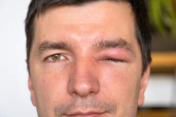 A red swollen eyelid on a man's face in close-up is an allergy to an insect bite. Allergic reaction to blood-sucking insects