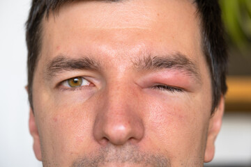Obraz premium A red swollen eyelid on a man's face in close-up is an allergy to an insect bite. Allergic reaction to blood-sucking insects