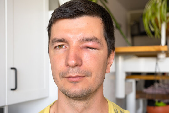 A red swollen eyelid on a man's face in close-up is an allergy to an insect bite. Allergic reaction to blood-sucking insects