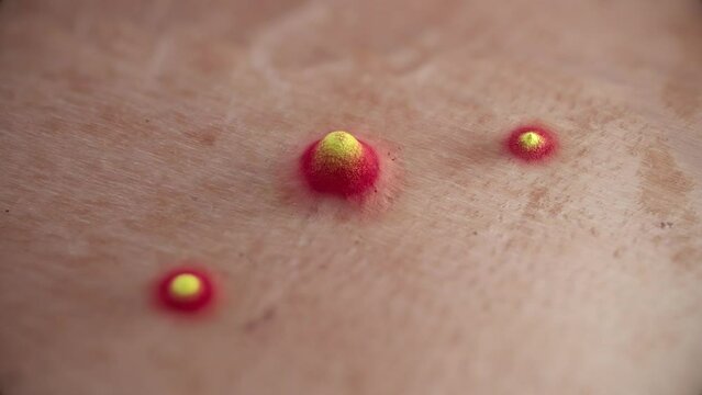 Treating Acne Skin With New Technology, 3D Visualization. Acne Zits Reducing in Size.