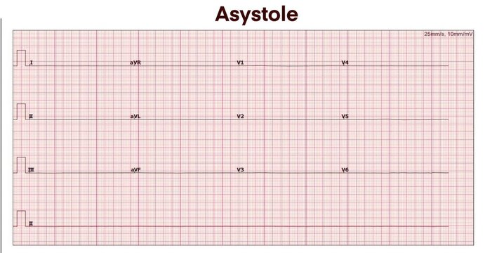 Electrocardiogram show asystole