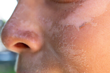 Naklejka premium Sun burn on a child's face skin, close up