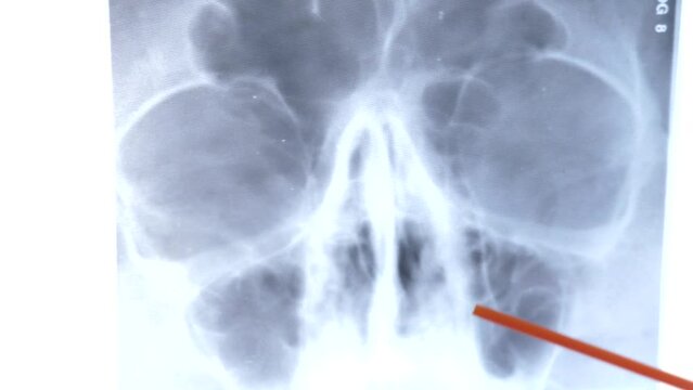 An X-ray of the maxillary sinuses is studied. Inflammation of the maxillary sinuses. diagnosis