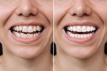 Cropped shot of a young caucasian smiling woman before and after veneers installation. Teeth whitening. Dentistry, dental treatment. Сorrection of uneven teeth with braces - obrazy, fototapety, plakaty