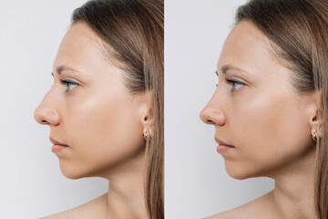 Profile of woman's face with nose before and after rhinoplasty isolated on gray background. The result of cosmetic plastic surgery on the nose. Correction of a nasal septum. Getting rid of the hump - obrazy, fototapety, plakaty