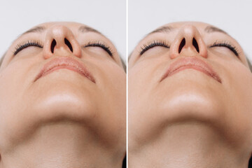 A close-up of woman's nose before and after rhinoplasty on gray background. The result of cosmetic...