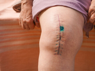 recovery and wound healing on the human body. scar from operation. postoperative suture on the male...