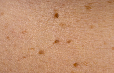 Nevus close-up. Mole on human skin. Irregular birthmark. - obrazy, fototapety, plakaty