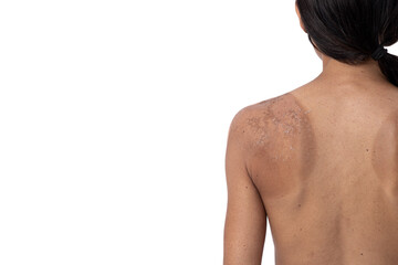 Naklejka premium Adult woman with sunburn on her back, isolated on white background with copy space.