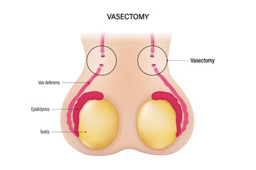 Vasectomy. Vasoligation. Male sterilization procedure vector. Permanent contraception.