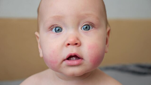 Baby girl with allergic reaction on cheekbones looks around with surprise. Small child with big blue eyes and red rash on cheeks portrait closeup