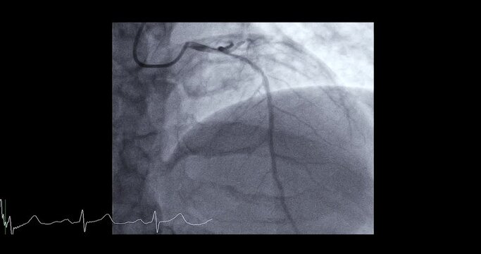 Cardiac catheterization showing coronary arteries  used to diagnose and treat some heart conditions such as myocardial infarction.