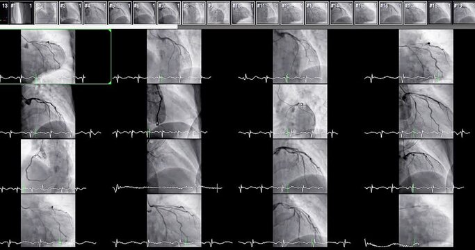 Cardiac catheterization showing coronary arteries  used to diagnose and treat some heart conditions such as myocardial infarction.