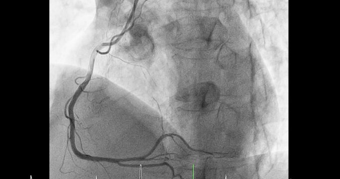 Cardiac catheterization showing coronary arteries  used to diagnose and treat some heart conditions such as myocardial infarction.