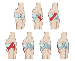 knee ligaments and menisci, with oblique popliteal ligament, medial fascicle of arcuate popliteal ligament, lateral fascicle of arcuate popliteal ligament and tibial collateral ligament 