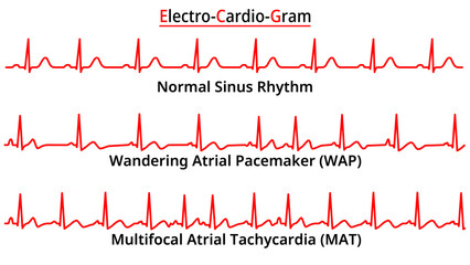 Set of ECG Common Abnormalities - Wandering Atrial Pacemaker (WAP) - Multifocal Atrial Tachycardia (MAT) - Electrocardiography Vector Medical Illustration - obrazy, fototapety, plakaty