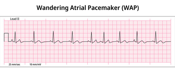 ECG Wandering Atrial Pacemaker (WAP) - 8 Second ECG Paper - Electrocardiography Vector Medical Illustration - obrazy, fototapety, plakaty