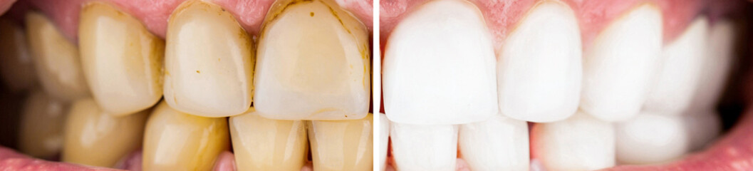 Man before and after teeth whitening procedure, closeup. Male teeth before and after whitening,...