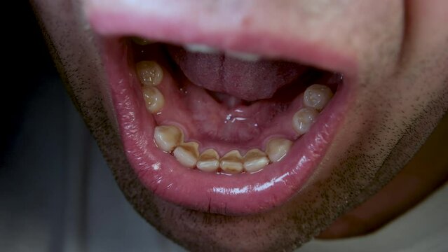 Close up of male wide open mouth while exposing his yellowish back of teeth and some missing and rotten teeth.