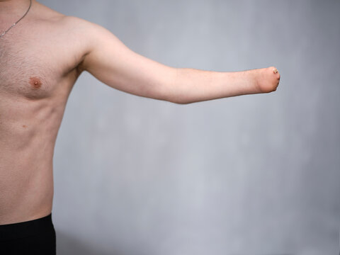 a man with an amputated aplasia of a hand without a prosthesis