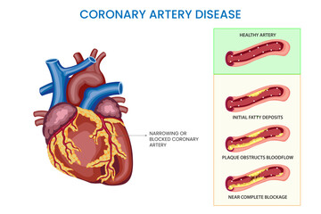 Coronary artery disease is a condition where the coronary arteries narrowed or blocked, reducing blood flow to the heart and increasing the risk of heart attacks and other cardiovascular complications - obrazy, fototapety, plakaty