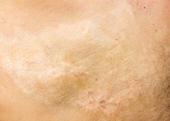 Burn scars, burn scars on the body. Consequences of burns.