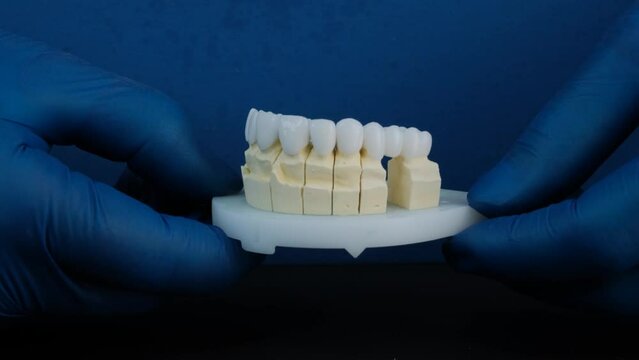 Model with dental veneers created by the dental technician