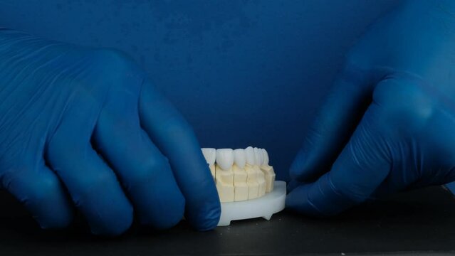 Model with dental veneers created by the dental technician