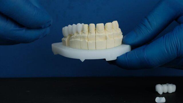 Model with dental veneers created by the dental technician