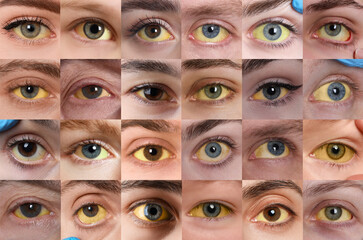 Yellowing of eyes as symptom of hepatitis. Collage with photos of people