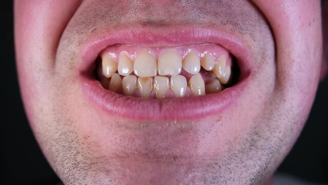 Close up of slightly yellowish adult male teeth while grinding top and bottom jaw with some missing teeth and or spaces in back. 