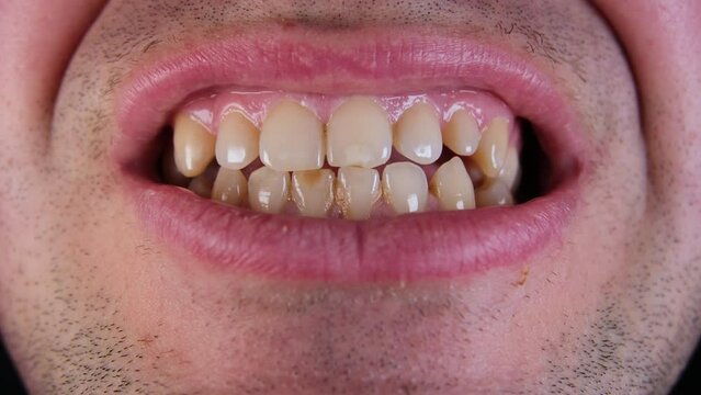 Close up while grinding slightly yellowish adult male teeth with some missing teeth and or spaces in back.