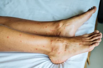 Foto op Plexiglas Skin damaged by insect bites © Iurii