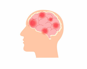 Hemorrhagic human brain stroke problem bleeding in human head medical and health care concept.