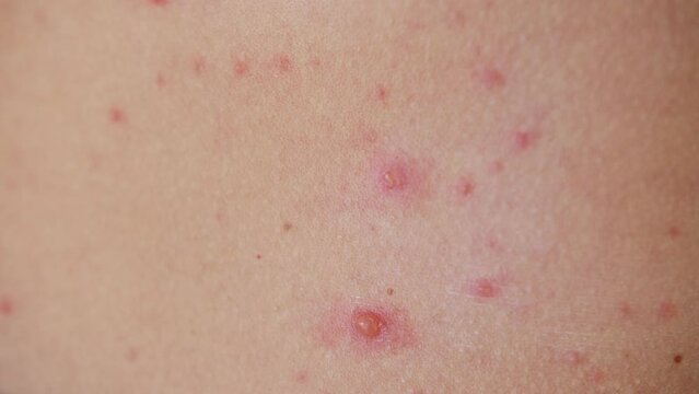 The classic symptom of chickenpox is a rash that turns into itchy, fluid-filled blisters.